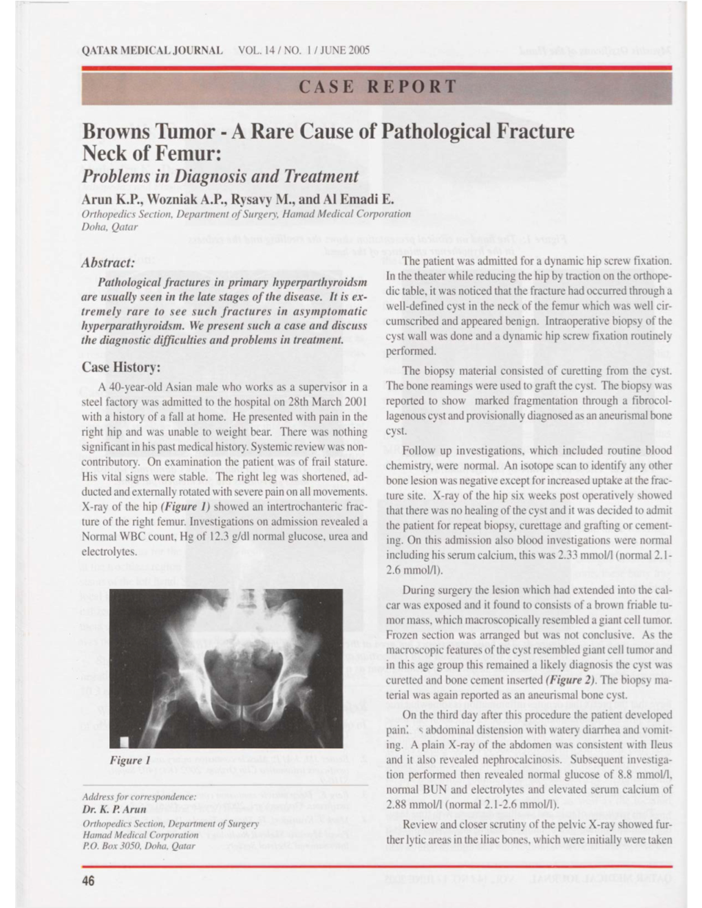 Browns Tumor - a Rare Cause of Pathological Fracture Neck of Femur: Problems in Diagnosis and Treatment Arun K.P., Wozniak A.P., Rysavy M., and Al Emadi E
