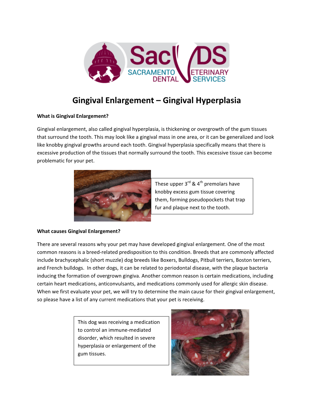 Gingival Enlargement – Gingival Hyperplasia