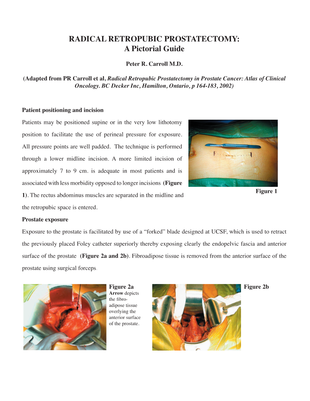 RADICAL RETROPUBIC PROSTATECTOMY: a Pictorial Guide