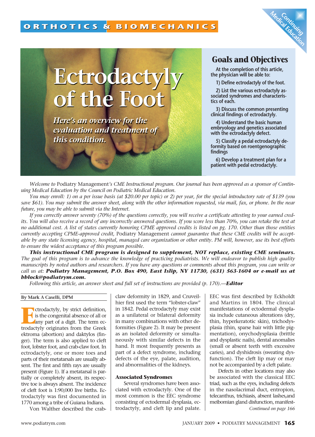 Ectrodactyly of the Foot