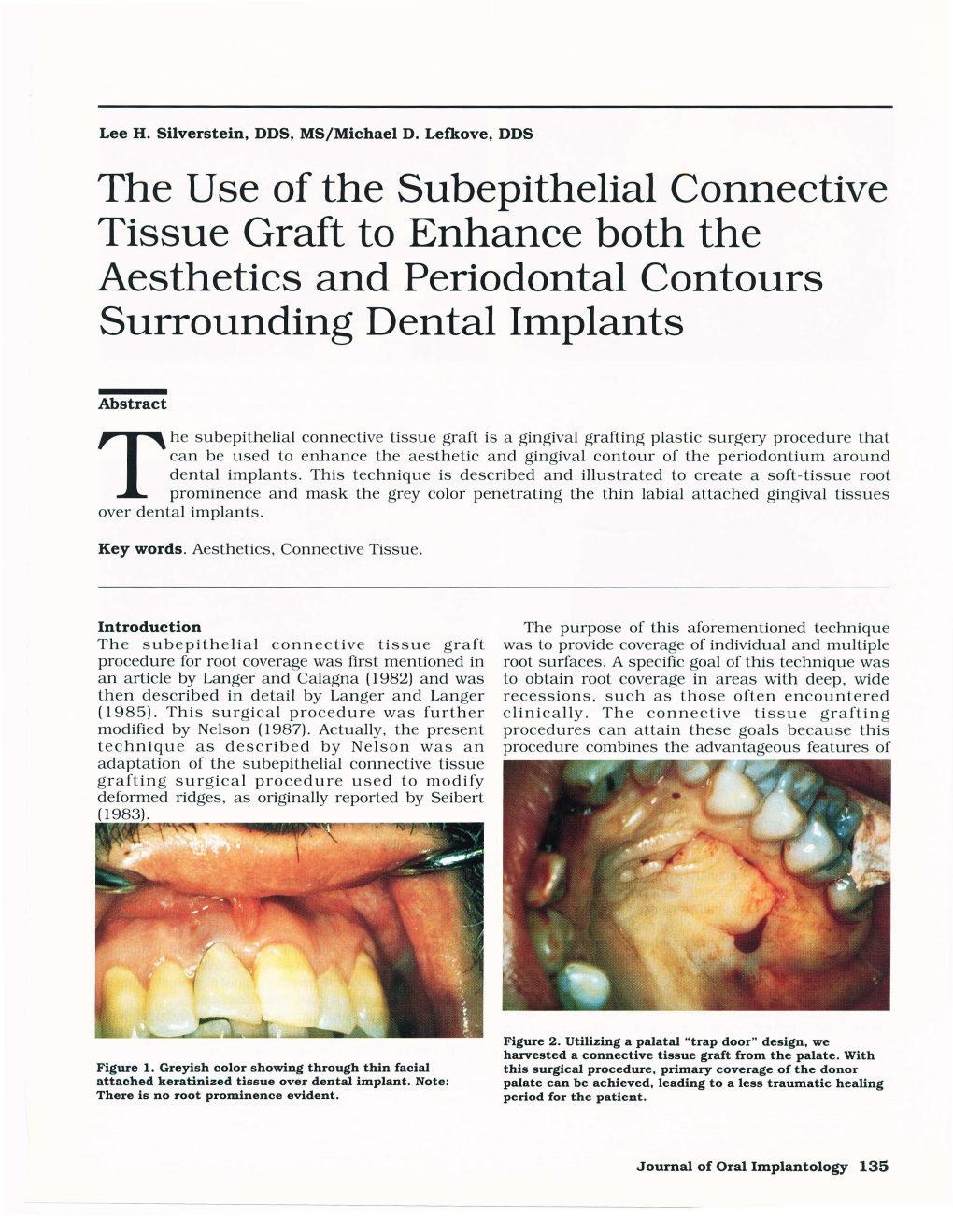 Tissue Graft to Enhance Both the Aesthetics and Periodontal Contours Surrounding Dental Implants