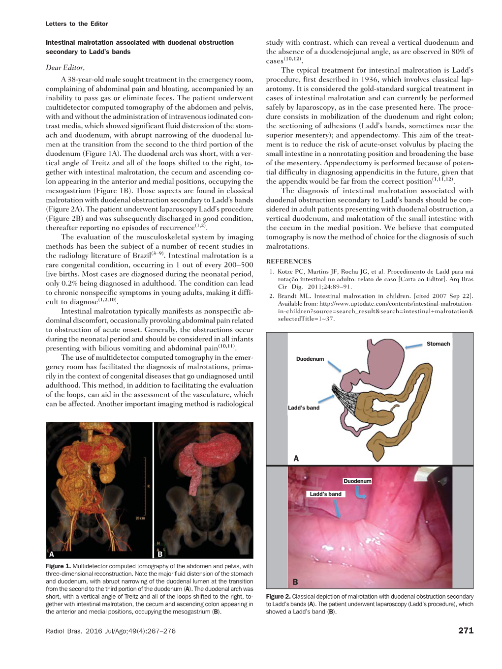 Intestinal Malrotation Associated with Duodenal Obstruction Secondary To