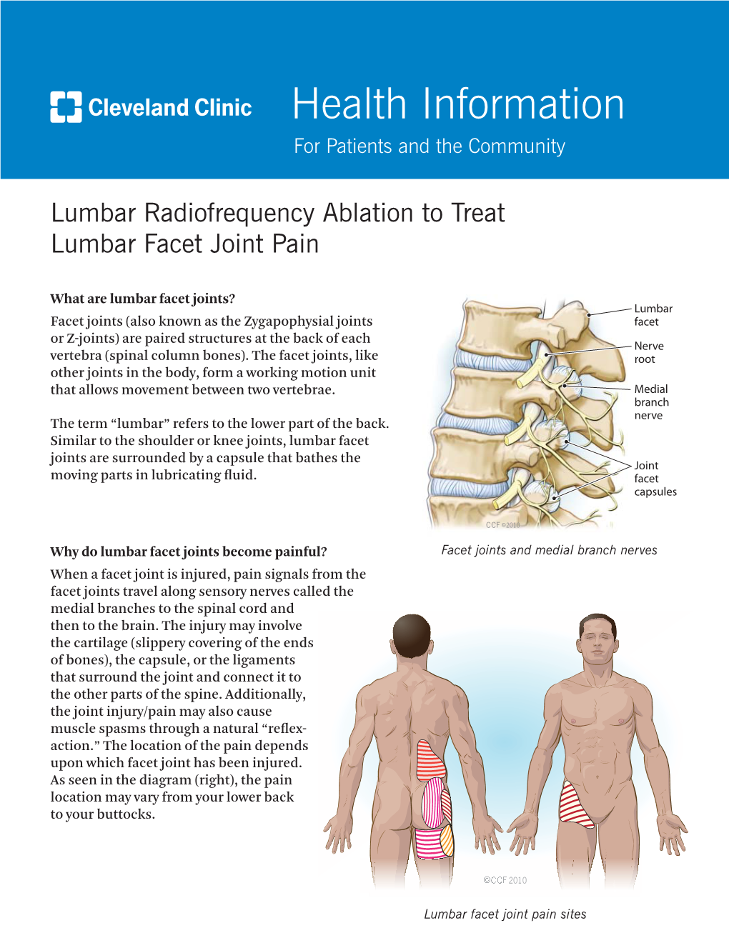 Lumbar Radiofrequency Ablation to Treat Lumbar Facet Joint Pain