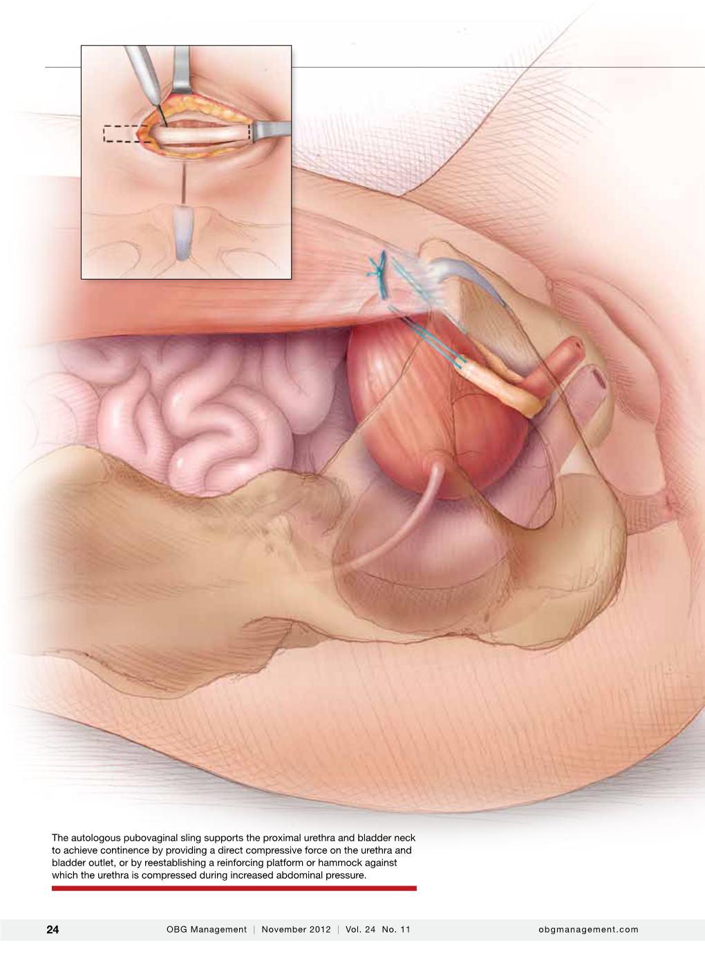 The Autologous Pubovaginal Sling Supports the Proximal Urethra And