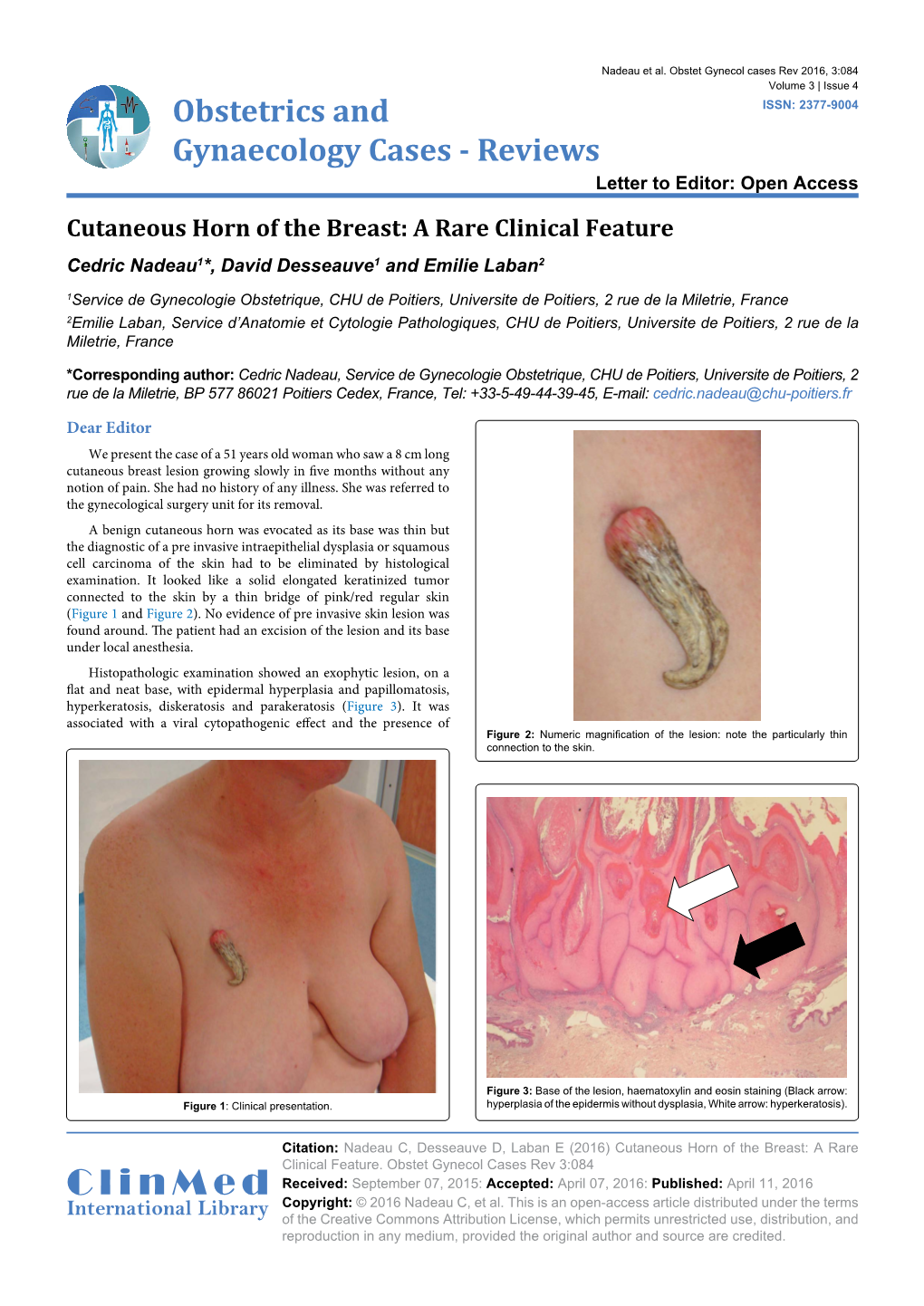 Cutaneous Horn of the Breast: a Rare Clinical Feature Cedric Nadeau1*, David Desseauve1 and Emilie Laban2