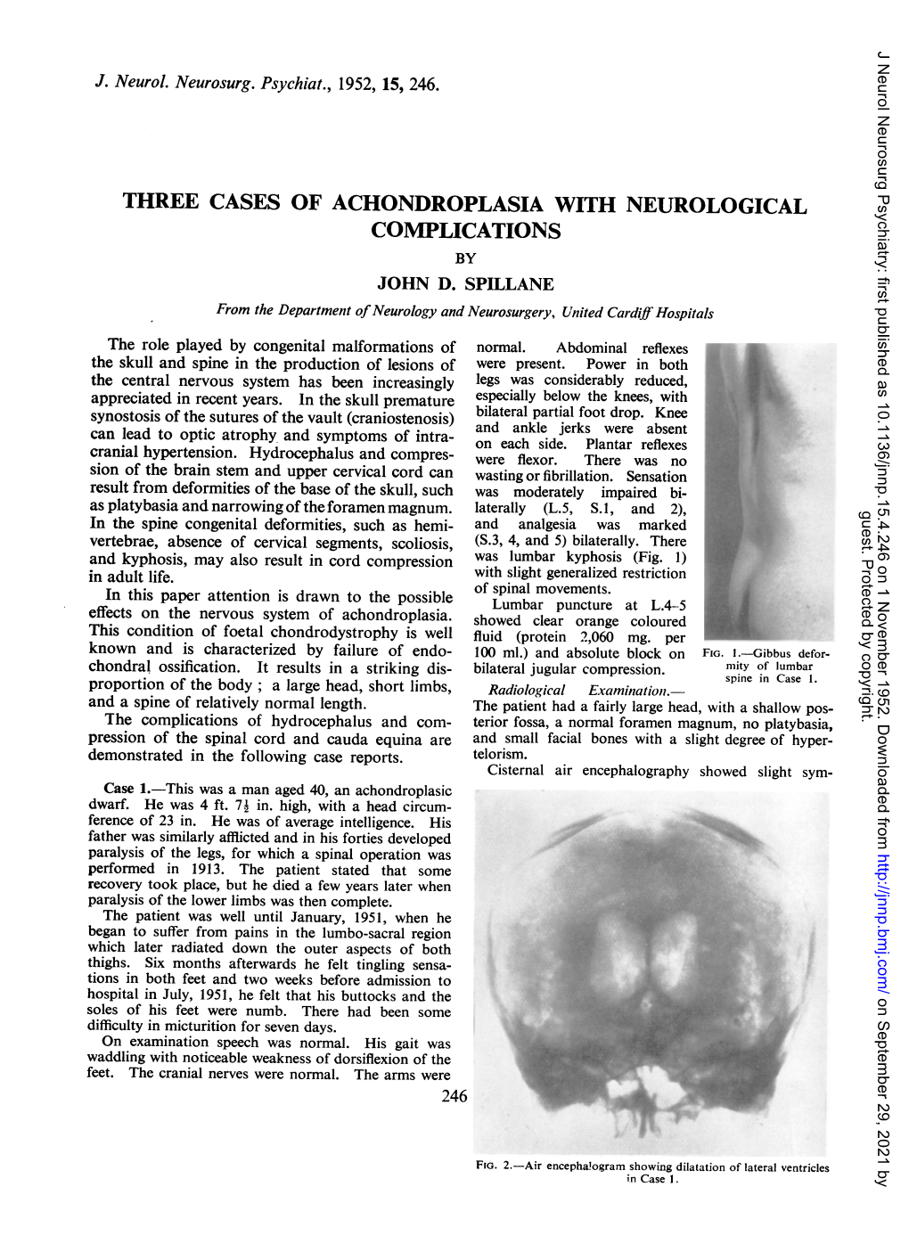 Three Cases of Achondroplasia with Neurological Complications by John D