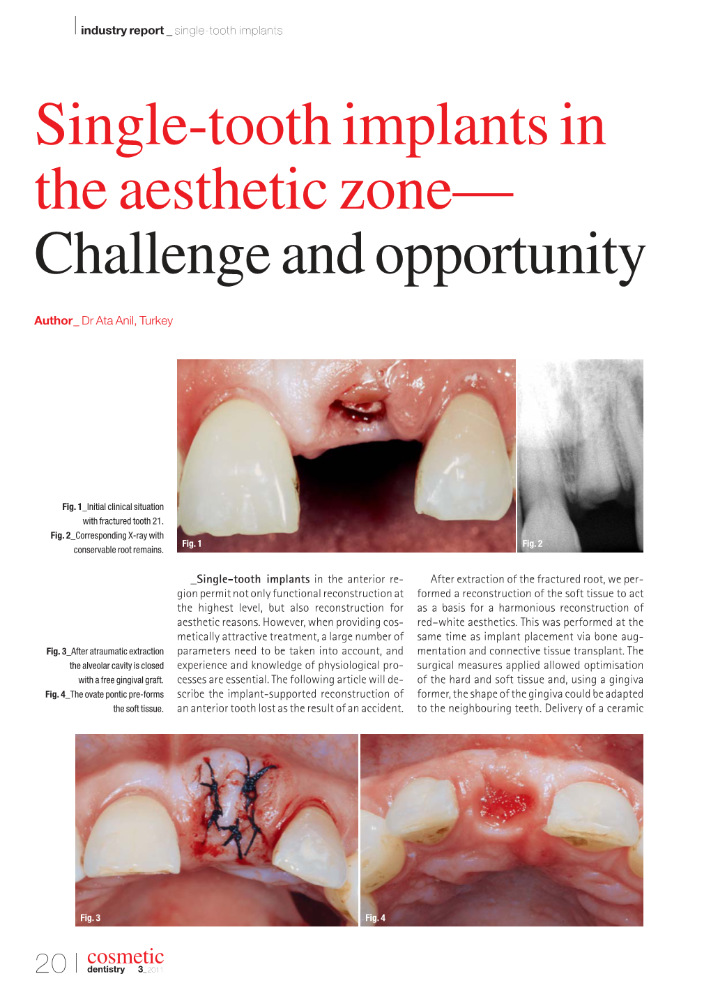 Single-Tooth Implants in the Aesthetic Zone— Challenge and Opportunity