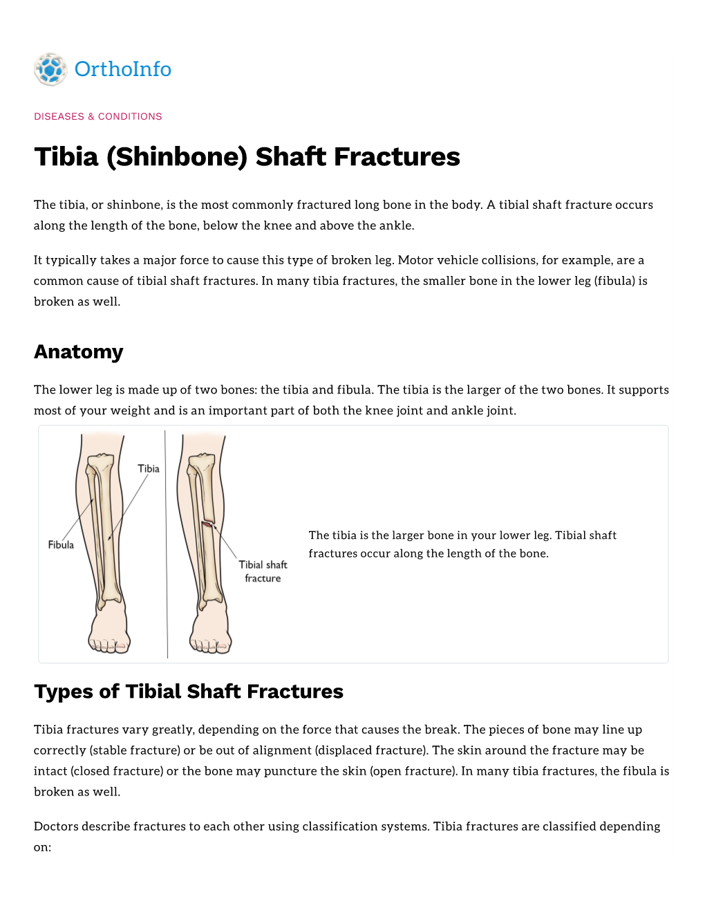 Shaft Fractures