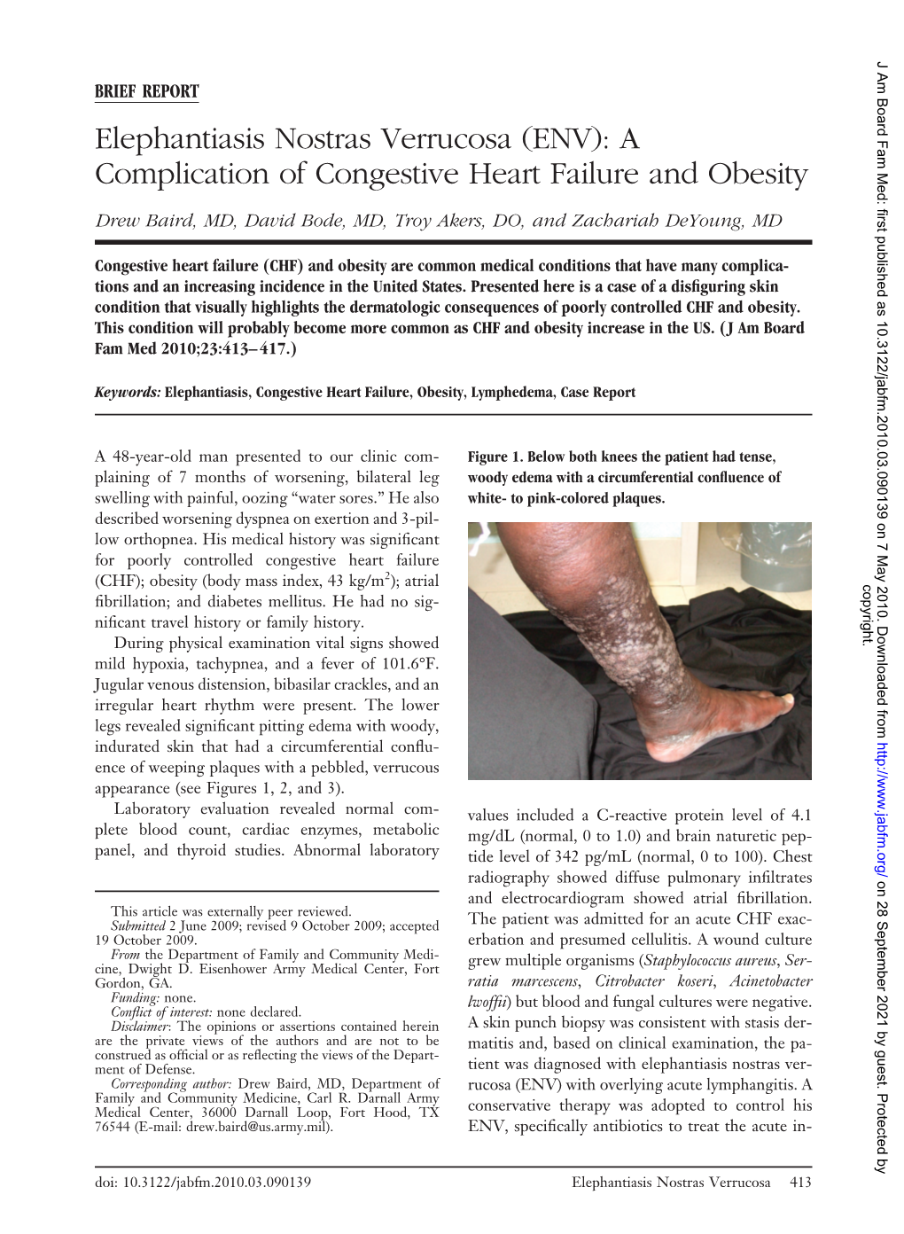 Elephantiasis Nostras Verrucosa (ENV): a Complication of Congestive Heart Failure and Obesity