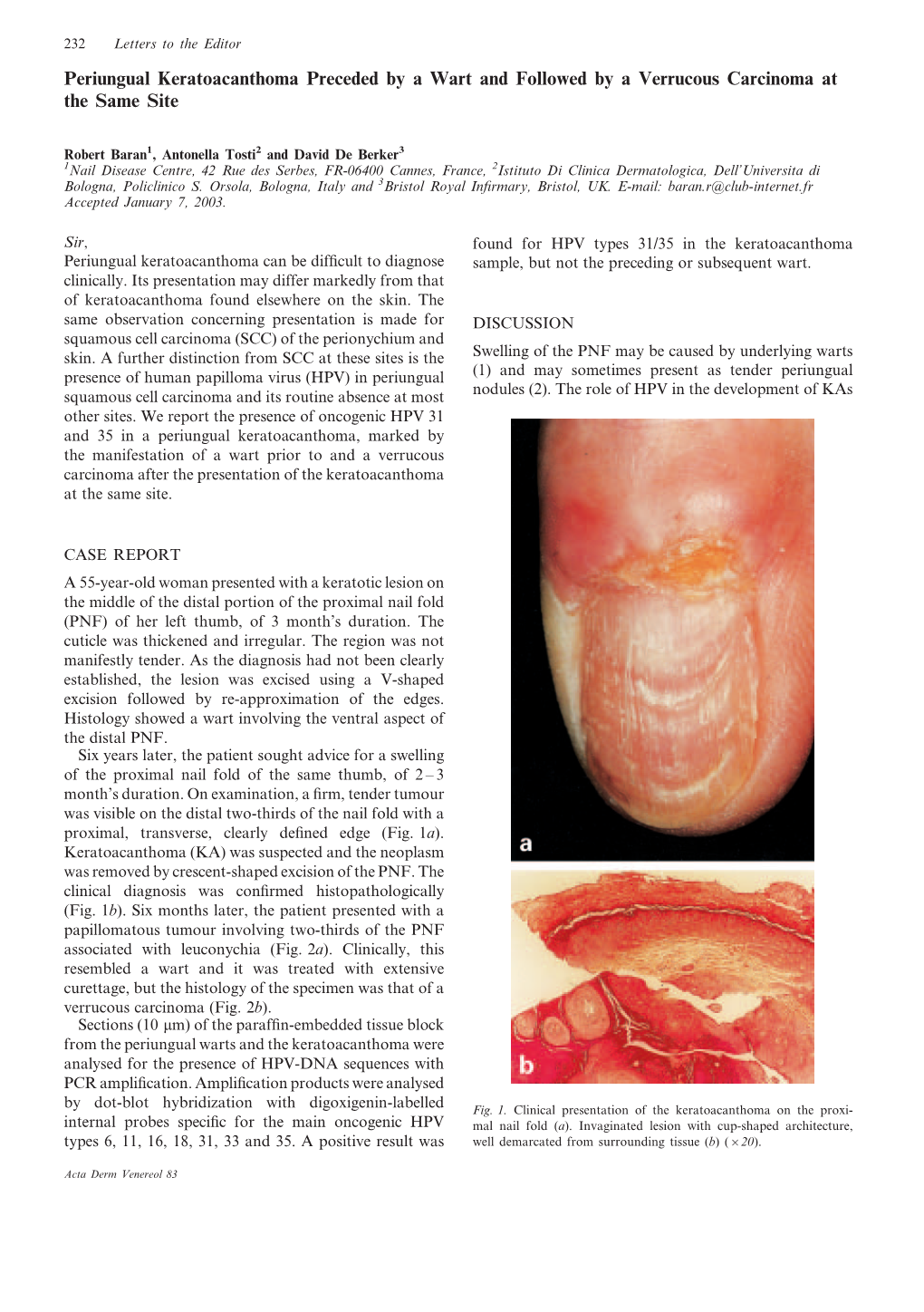 Periungual Keratoacanthoma Preceded by a Wart and Followed by a Verrucous Carcinoma at the Same Site