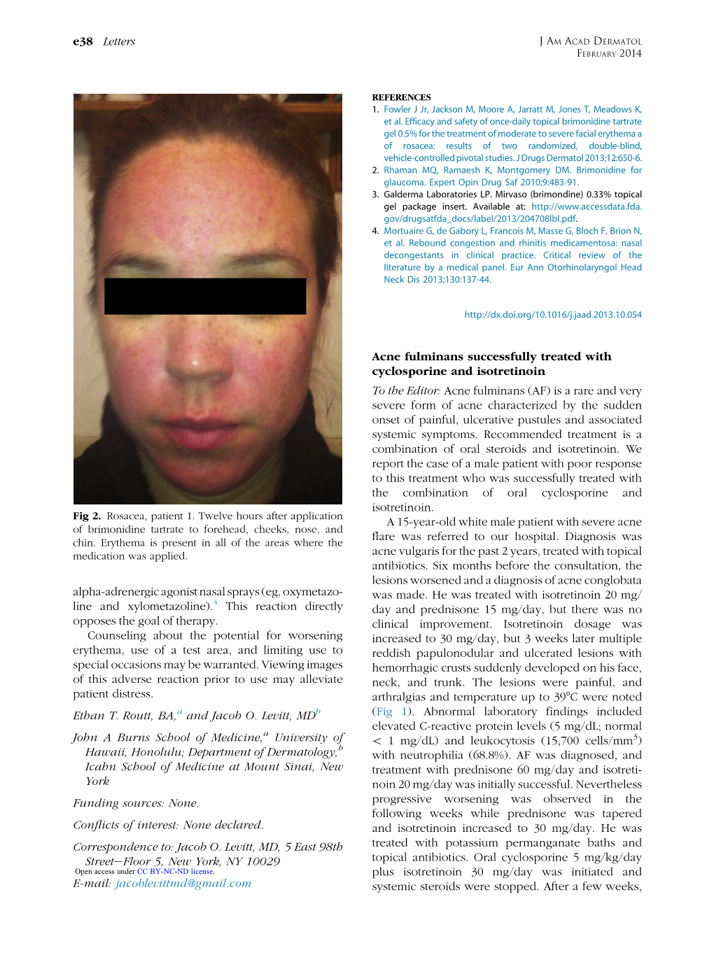 Acne Fulminans Successfully Treated with Cyclosporine and Isotretinoin