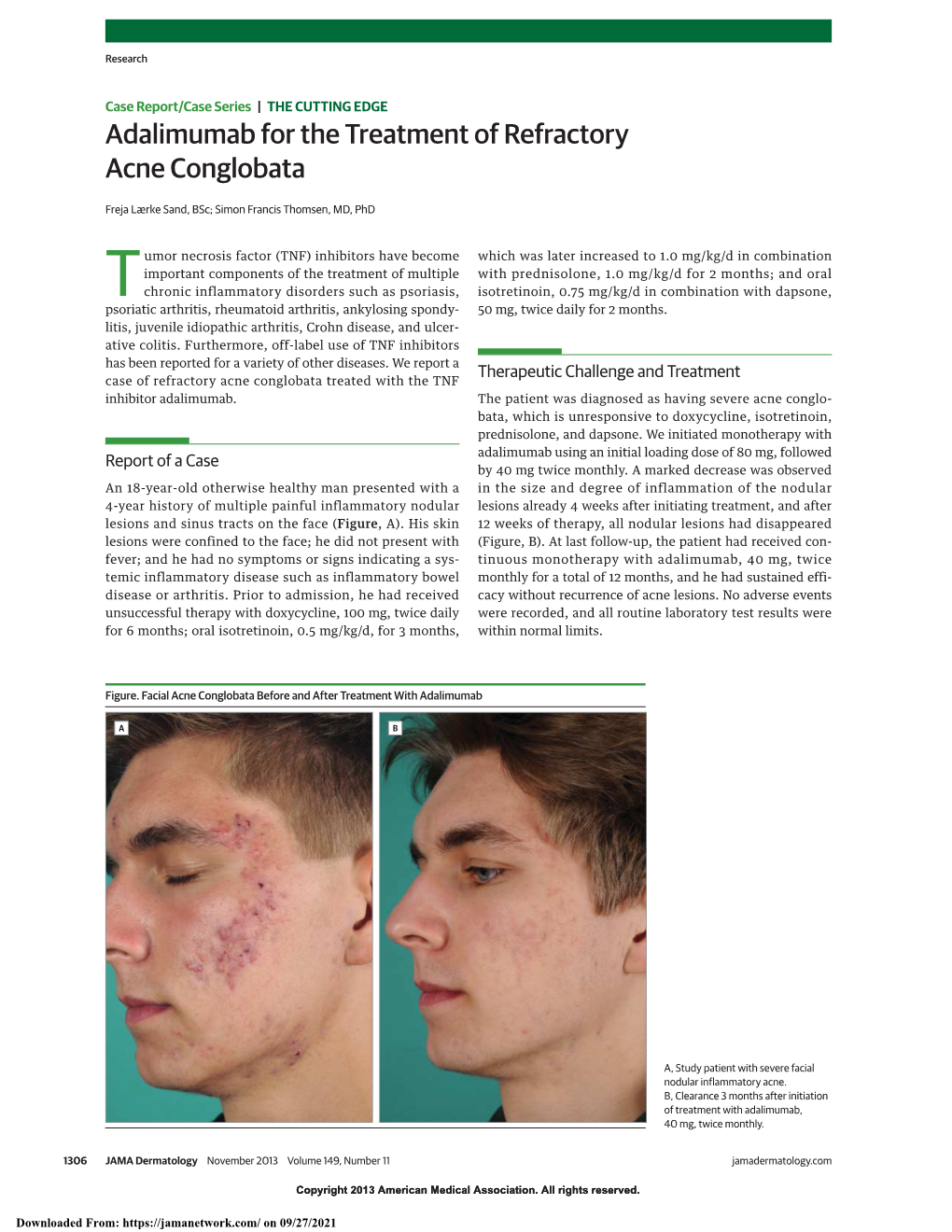 Adalimumab for the Treatment of Refractory Acne Conglobata