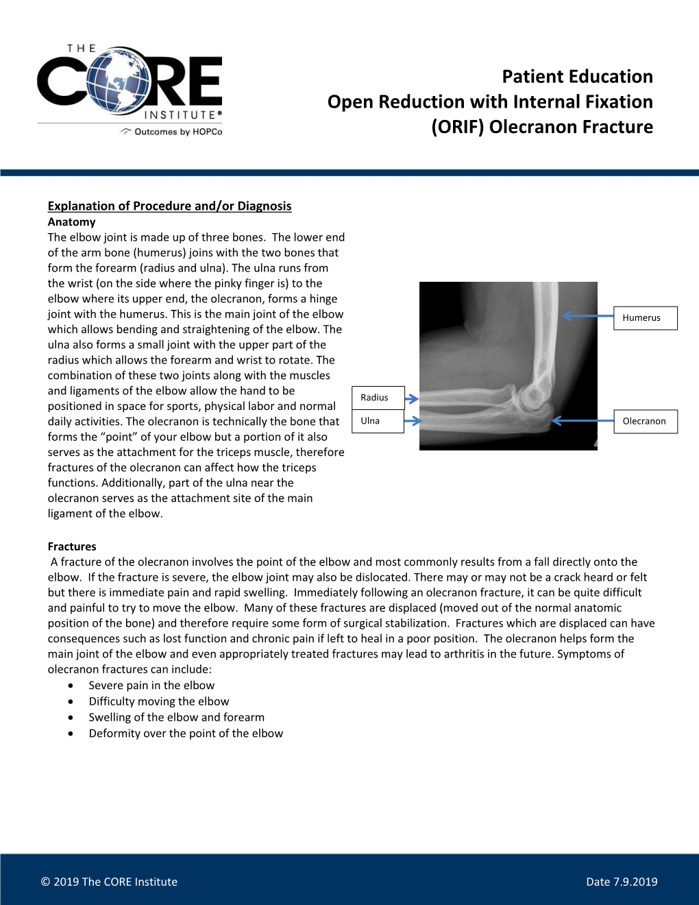 Open Reduction with Internal Fixation Olecranon Fracture