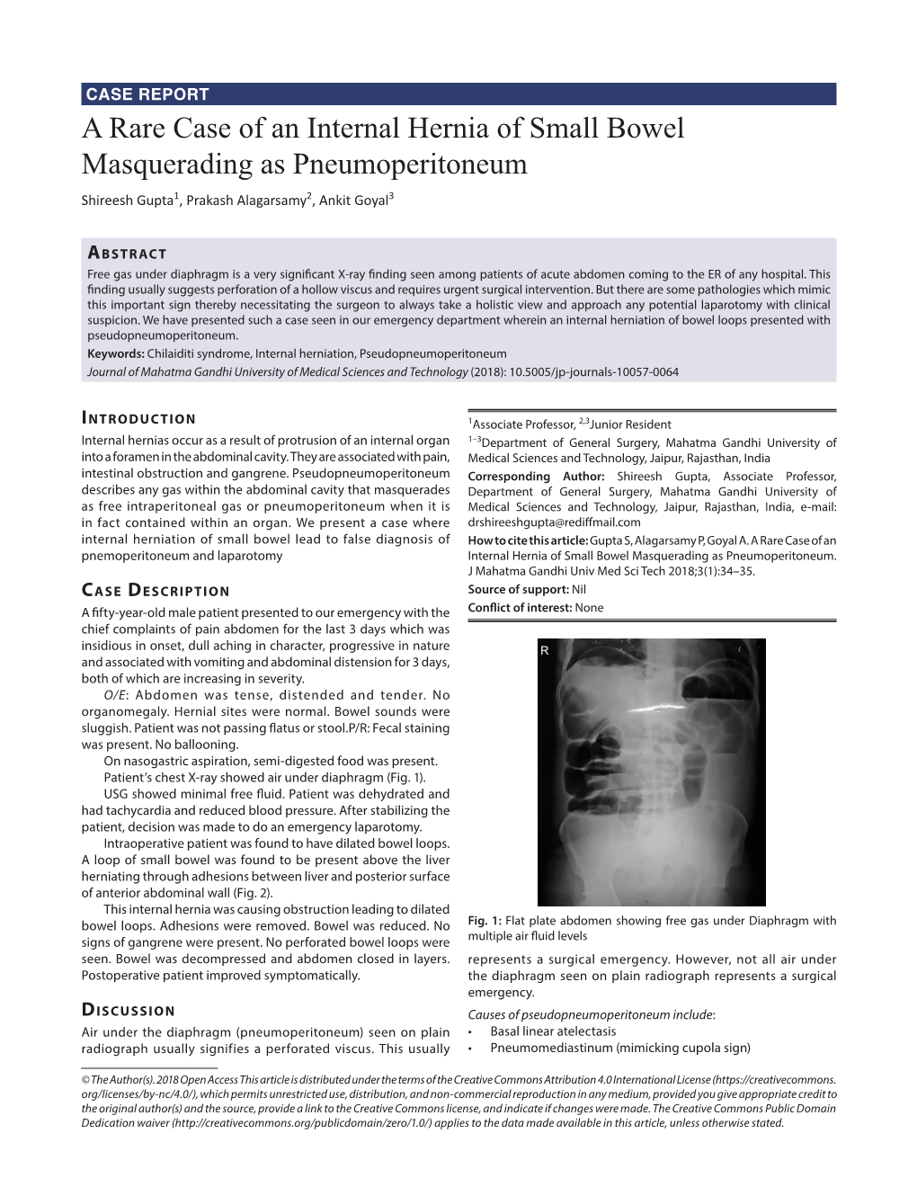 A Rare Case of an Internal Hernia of Small Bowel Masquerading As Pneumoperitoneum Shireesh Gupta1, Prakash Alagarsamy2, Ankit Goyal3