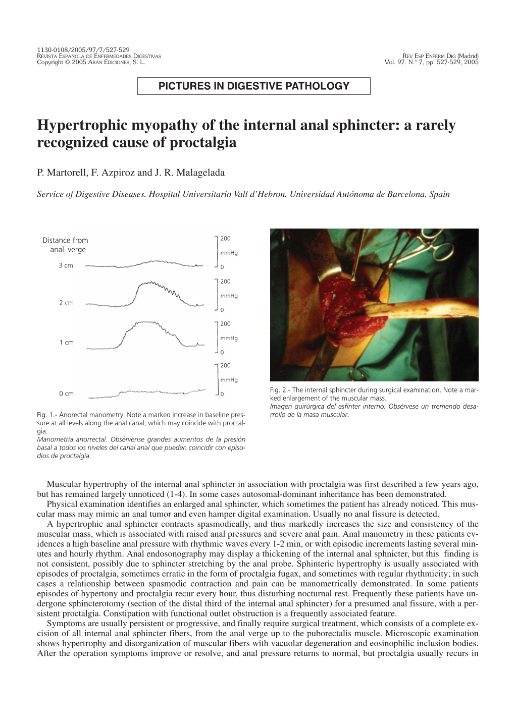 Hypertrophic Myopathy of the Internal Anal Sphincter: a Rarely Recognized Cause of Proctalgia