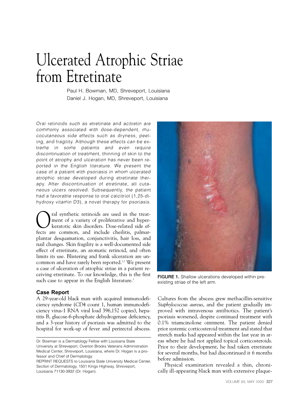 Ulcerated Atrophic Striae from Etretinate Paul H