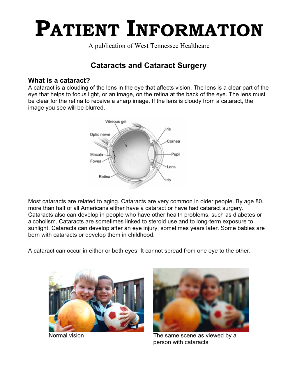 Cataract Surgery