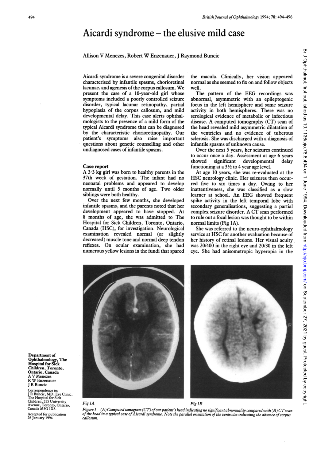 Aicardi Syndrome the Elusive Mild Case Br J Ophthalmol: First Published As 10.1136/Bjo.78.6.494 on 1 June 1994