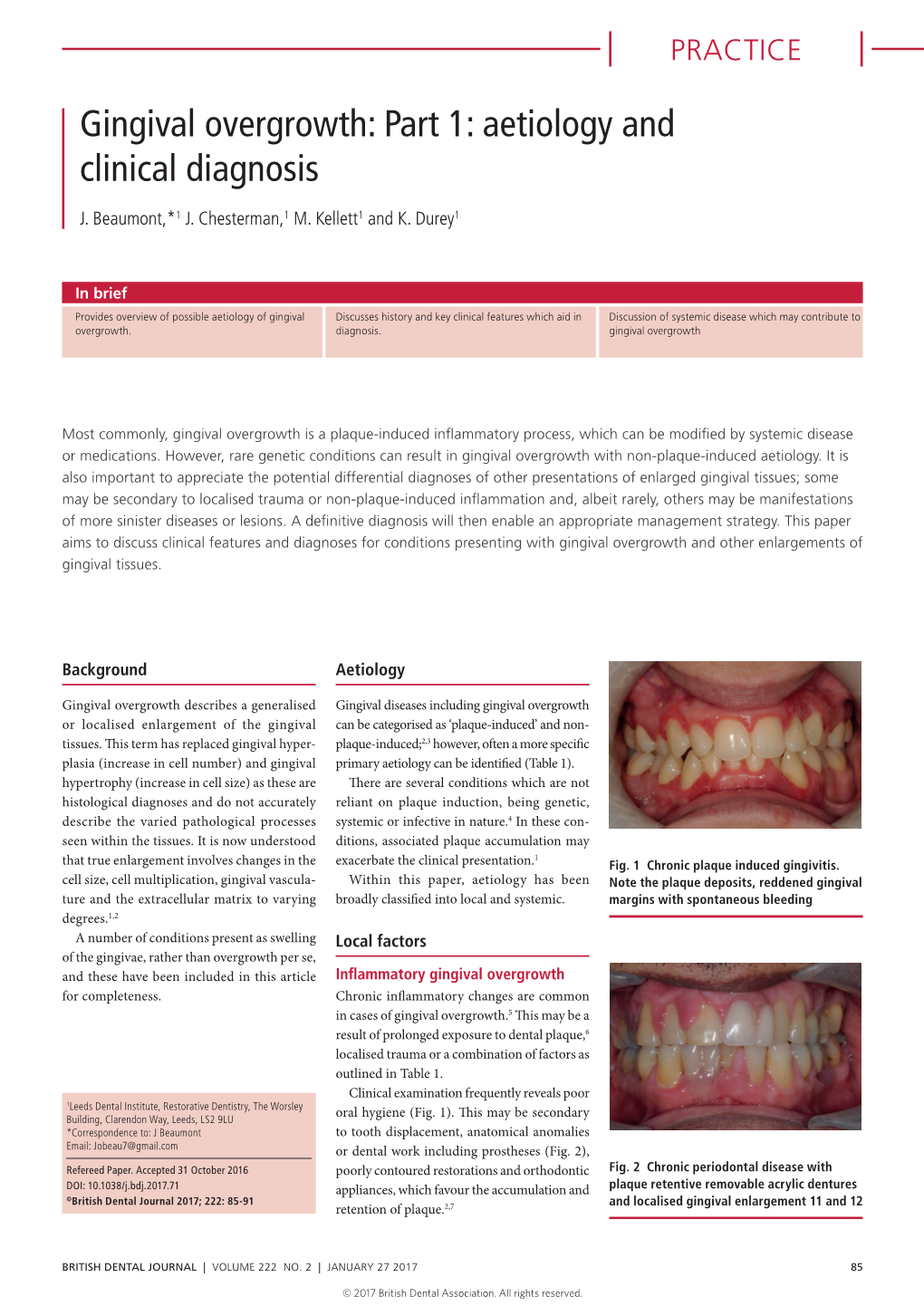 Gingival Overgrowth: Part 1: Aetiology and Clinical Diagnosis