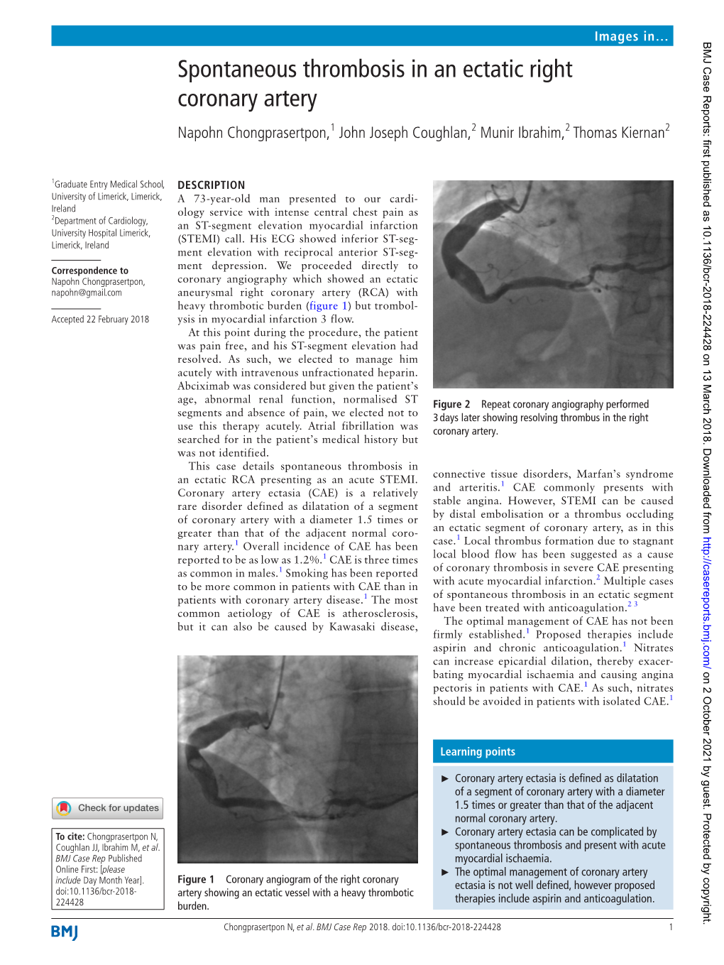 Spontaneous Thrombosis in an Ectatic Right Coronary Artery Napohn Chongprasertpon,1 John Joseph Coughlan,2 Munir Ibrahim,2 Thomas Kiernan2