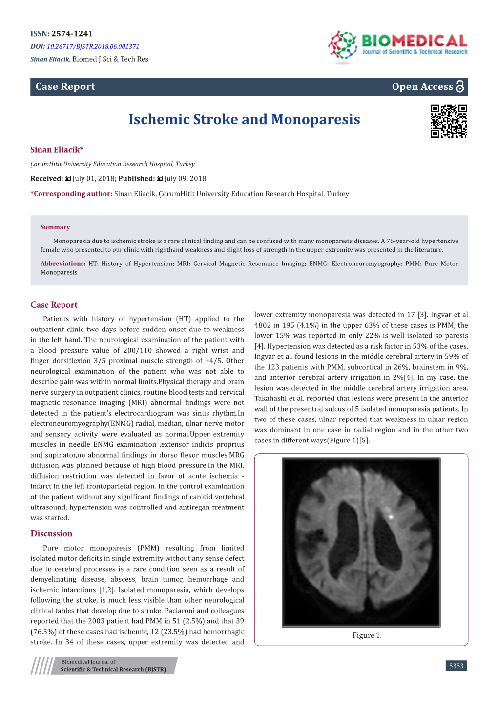 Ischemic Stroke and Monoparesis