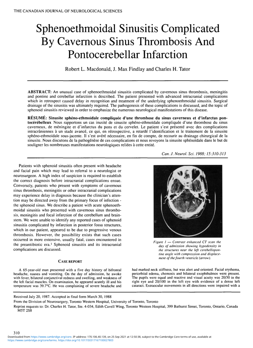 Sphenoethmoidal Sinusitis Complicated by Cavernous Sinus Thrombosis and Pontocerebellar Infarction