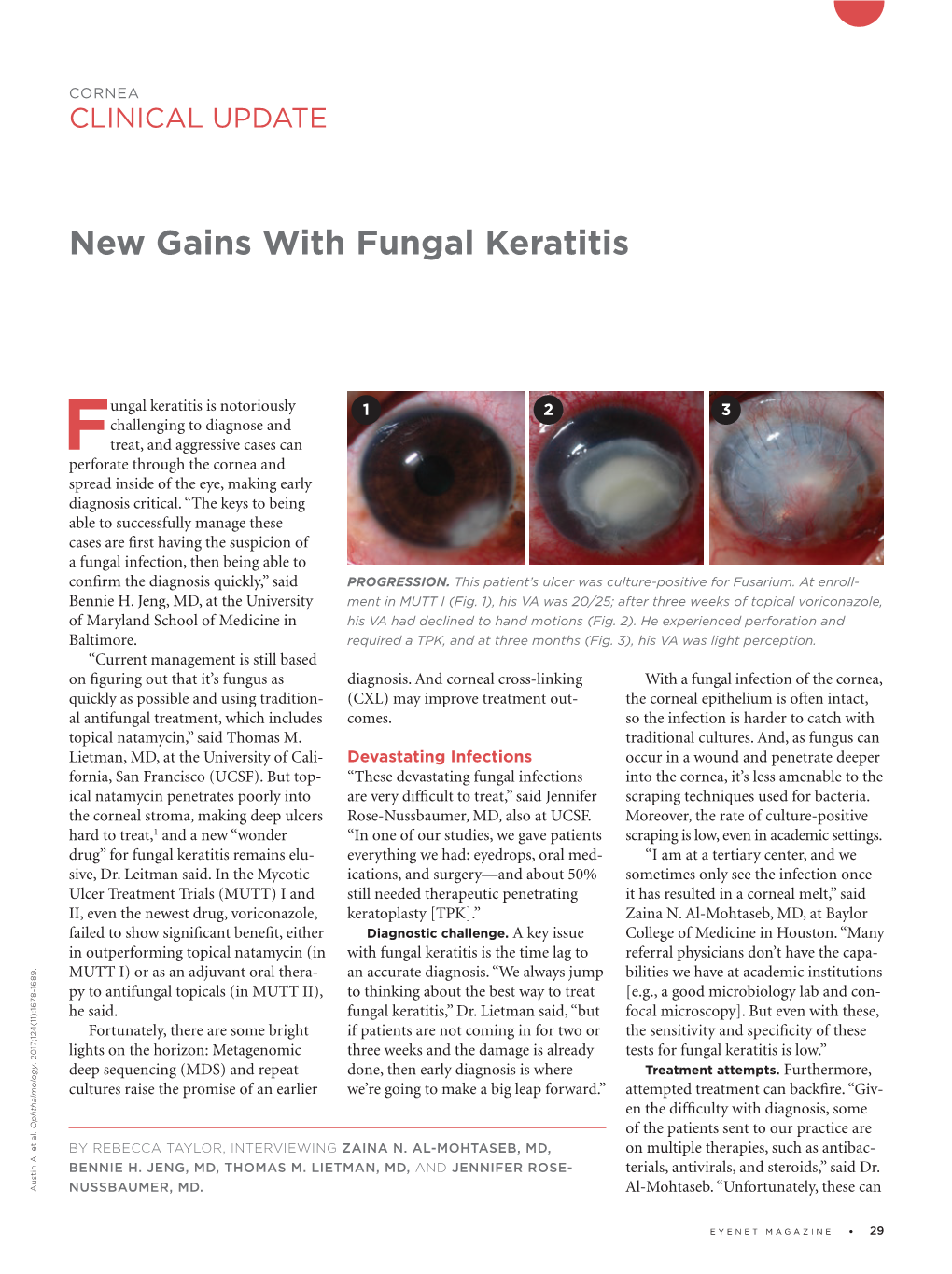 New Gains with Fungal Keratitis