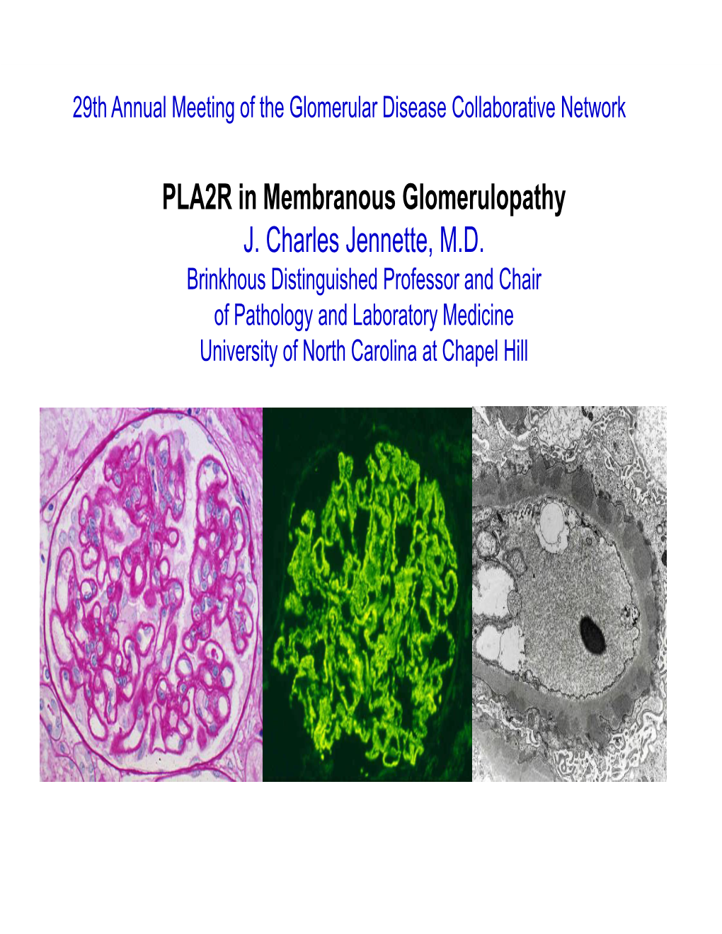 PLA2R in Membranous Glomerulopathy J