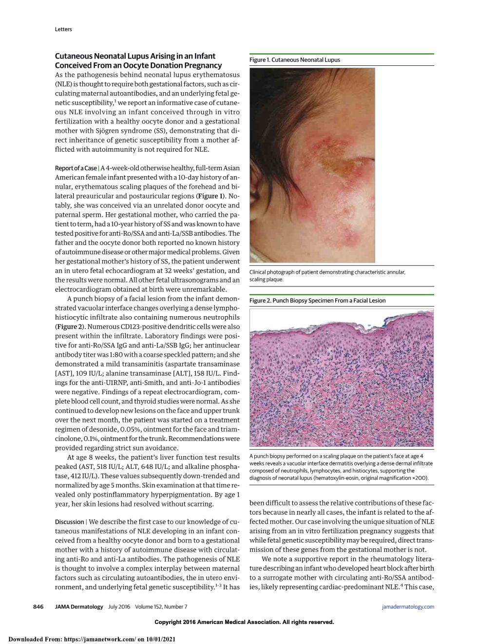 Cutaneous Neonatal Lupus Arising in an Infant Conceived from An