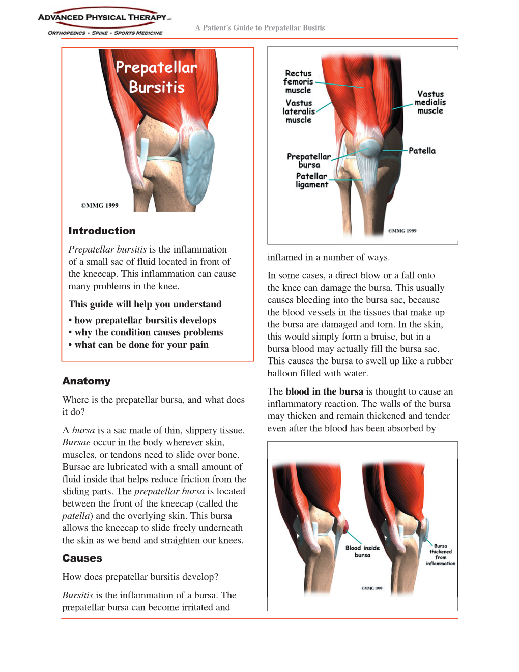 Prepatellar Bursitis Is the Inflammation of a Small Sac of Fluid Located in Front of Inflamed in a Number of Ways