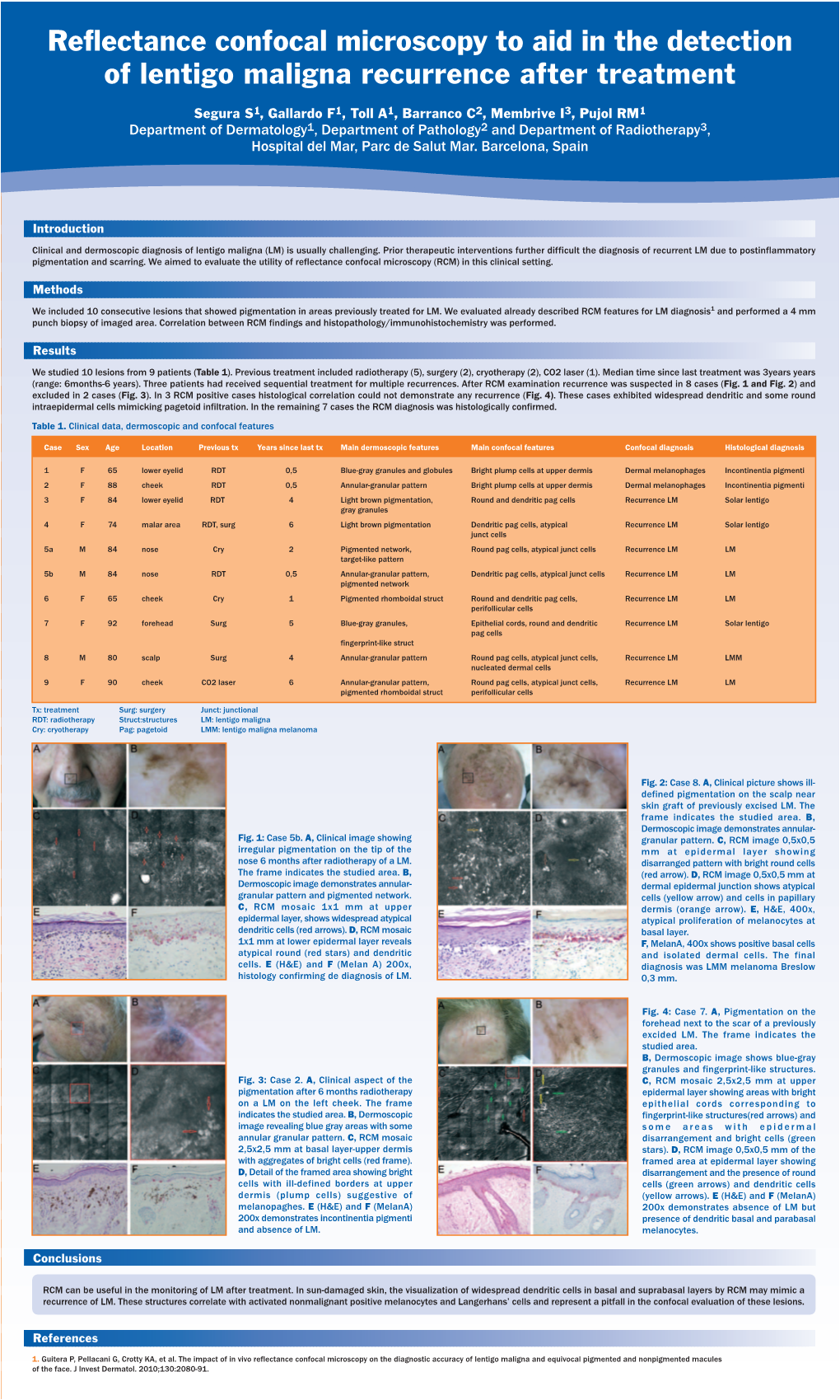 Reflectance Confocal Microscopy to Aid in the Detection of Lentigo Maligna Recurrence After Treatment