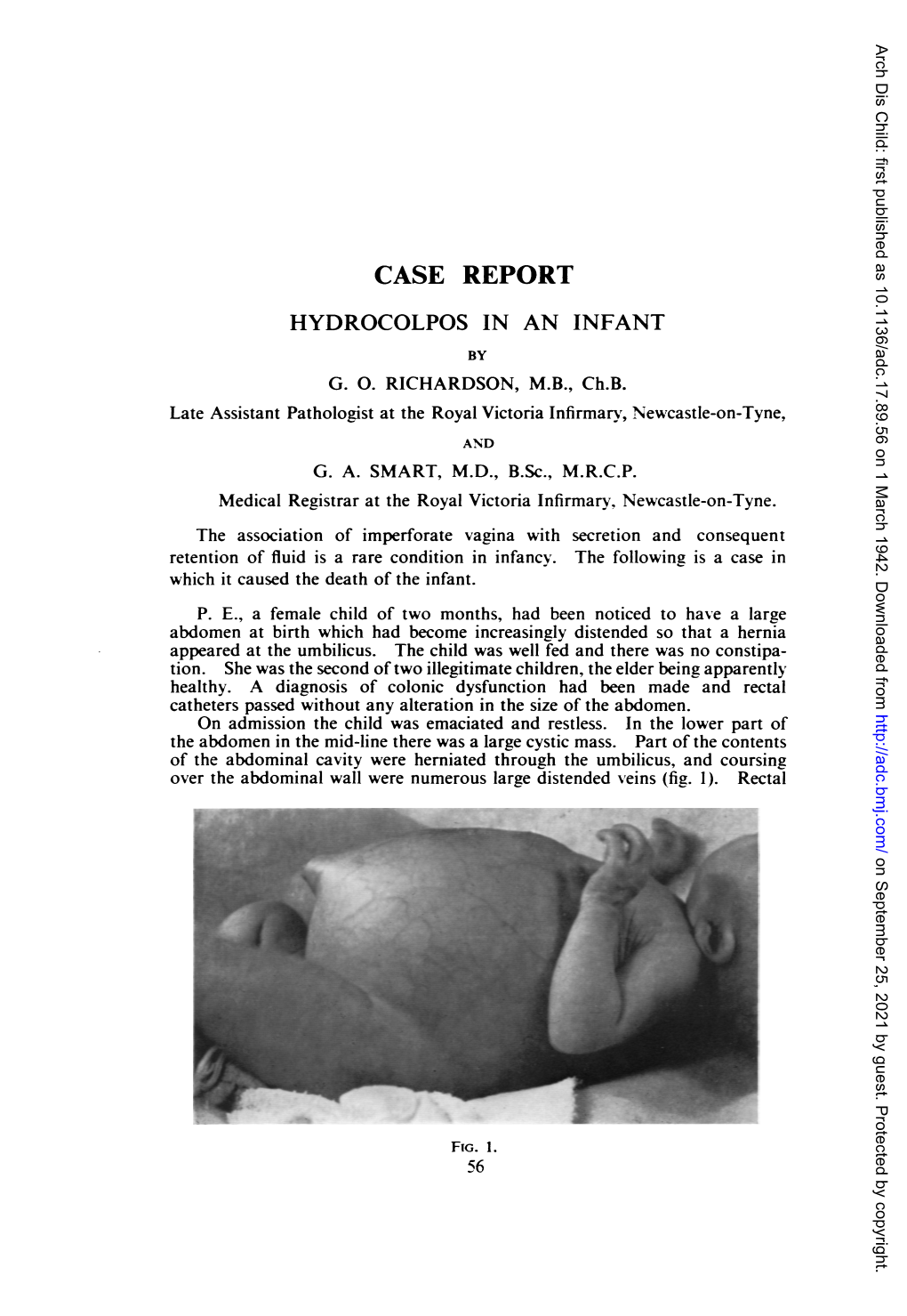 Case Report Hydrocolpos in an Infant by G