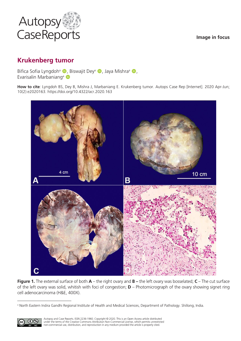 Krukenberg Tumor