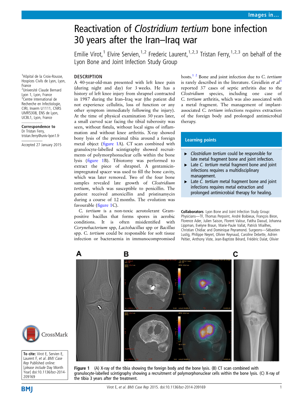 Reactivation of Clostridium Tertium Bone Infection 30 Years After The