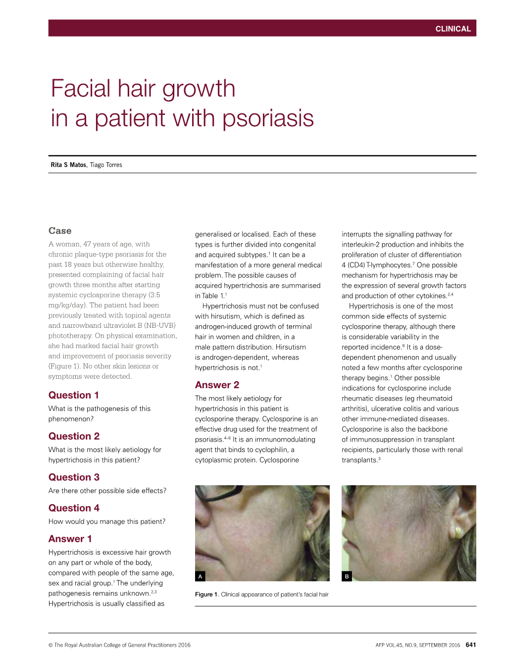Facial Hair Growth in a Patient with Psoriasis