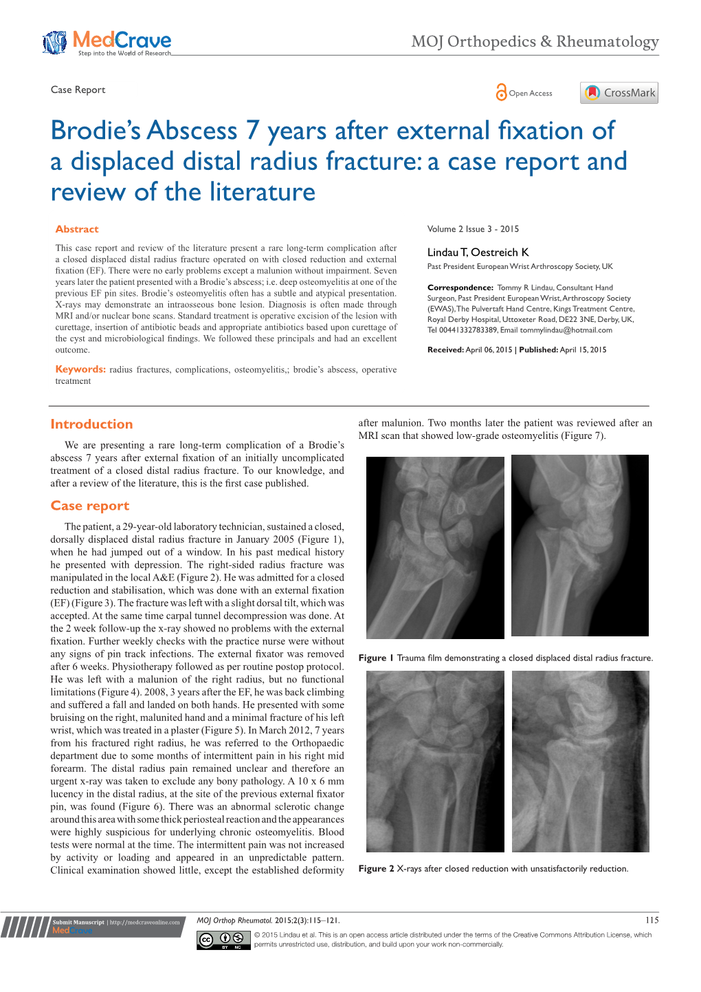 Brodie's Abscess 7 Years After External Fixation of A