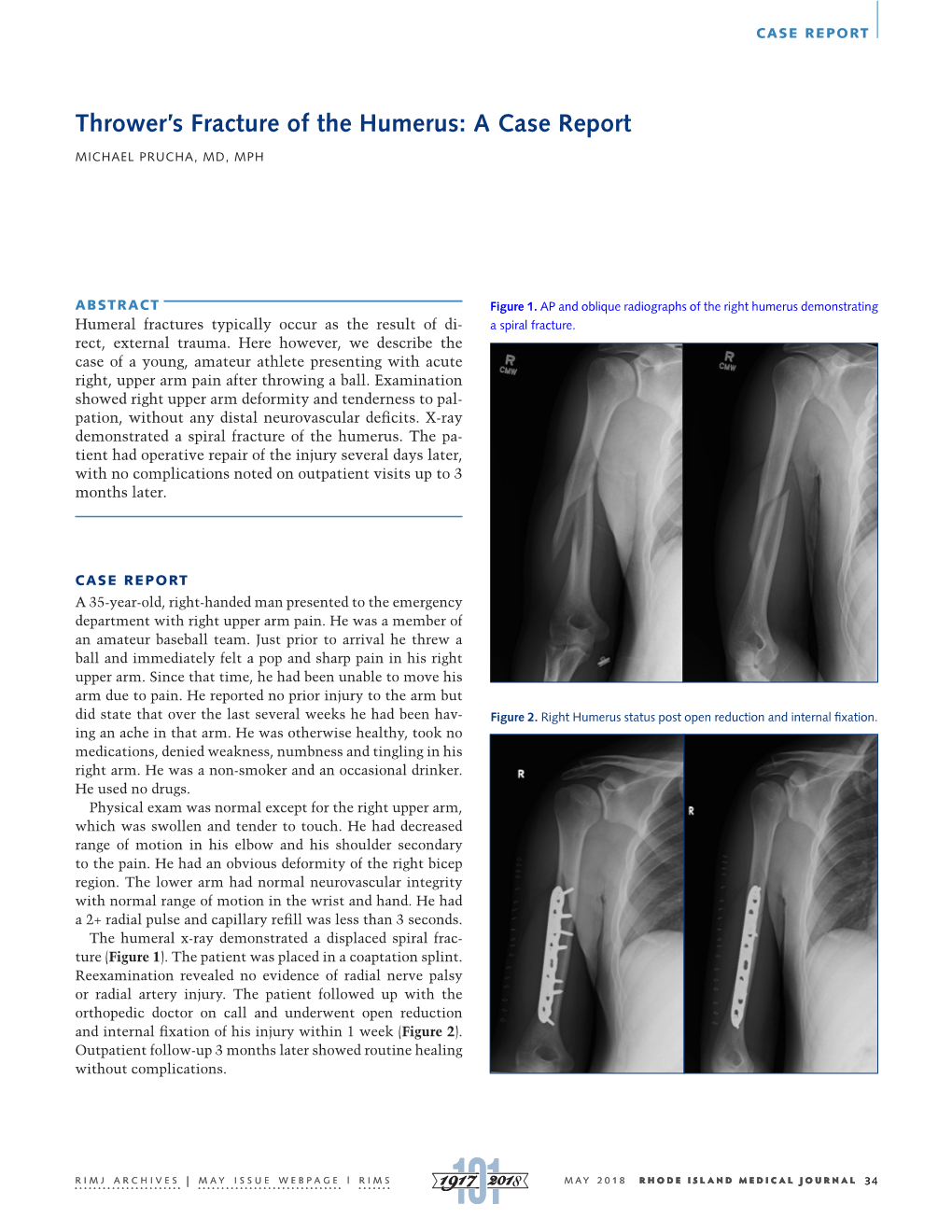 Thrower's Fracture of the Humerus: a Case Report