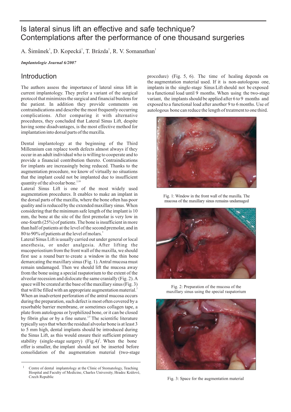 Is Lateral Sinus Lift an Effective and Safe Technique? Contemplations After the Performance of One Thousand Surgeries