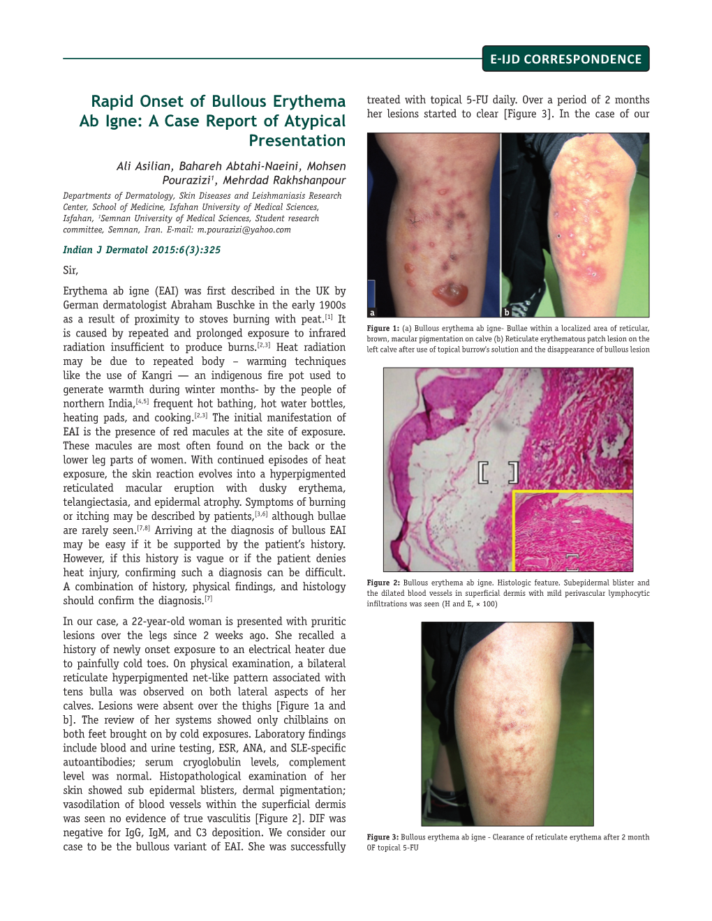 Rapid Onset of Bullous Erythema Ab Igne