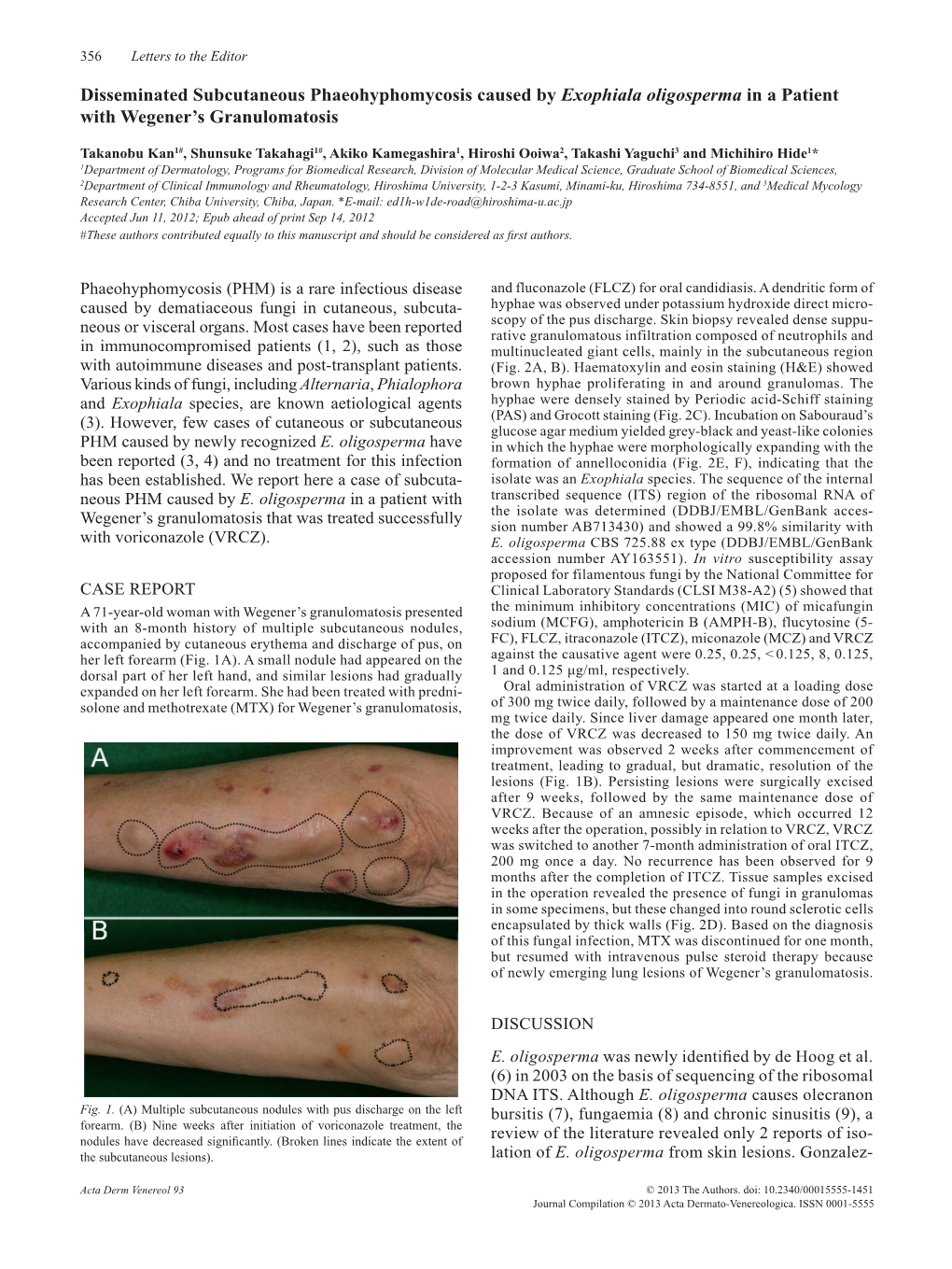 Disseminated Subcutaneous Phaeohyphomycosis Caused by Exophiala Oligosperma in a Patient with Wegener’S Granulomatosis