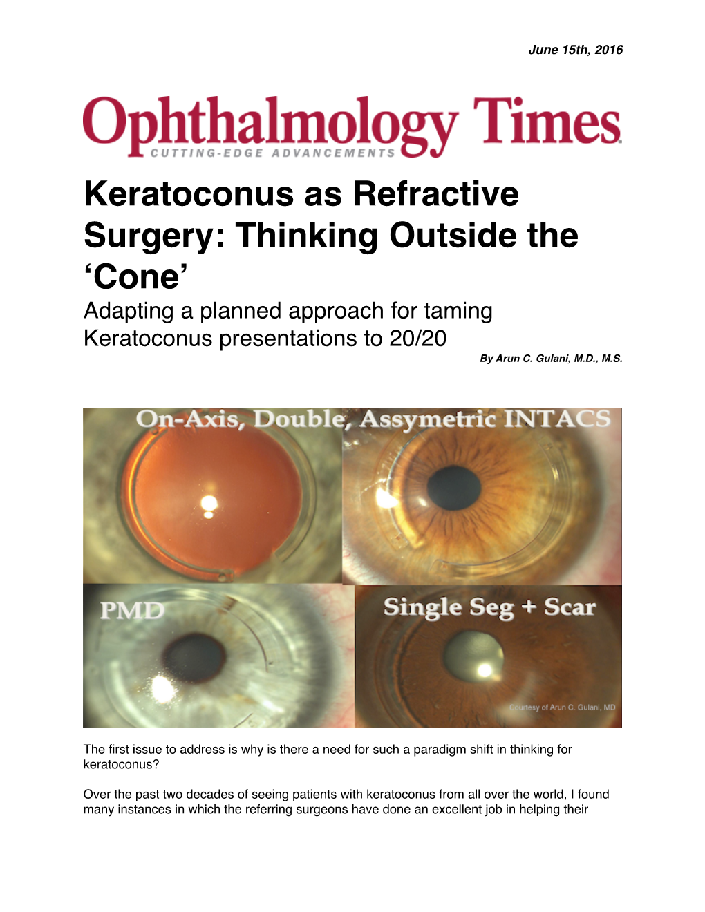 Keratoconus As Refractive Surgery: Thinking Outside the ‘Cone’ Adapting a Planned Approach for Taming Keratoconus Presentations to 20/20 by Arun C