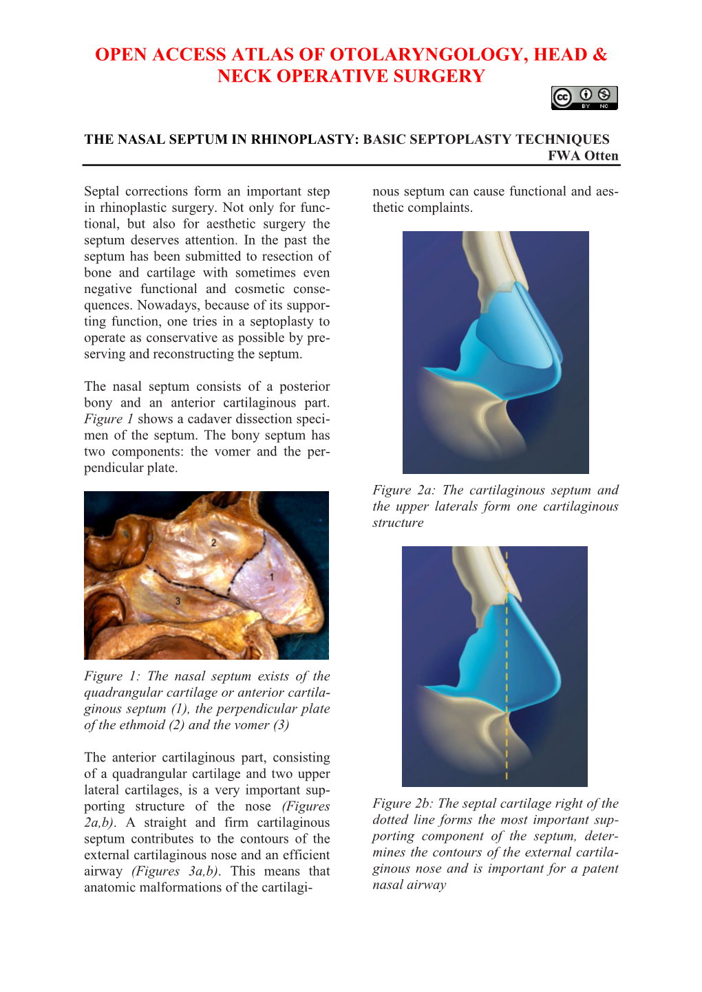 Septoplasty in Rhinoplasty Surgery