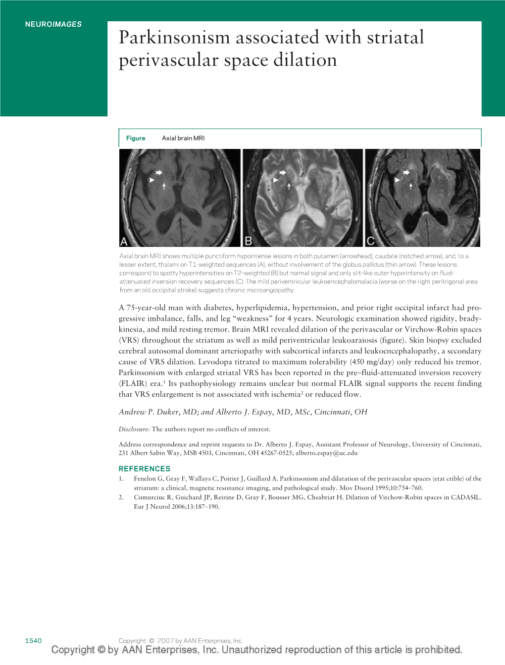 Parkinsonism Associated with Striatal Perivascular Space Dilation