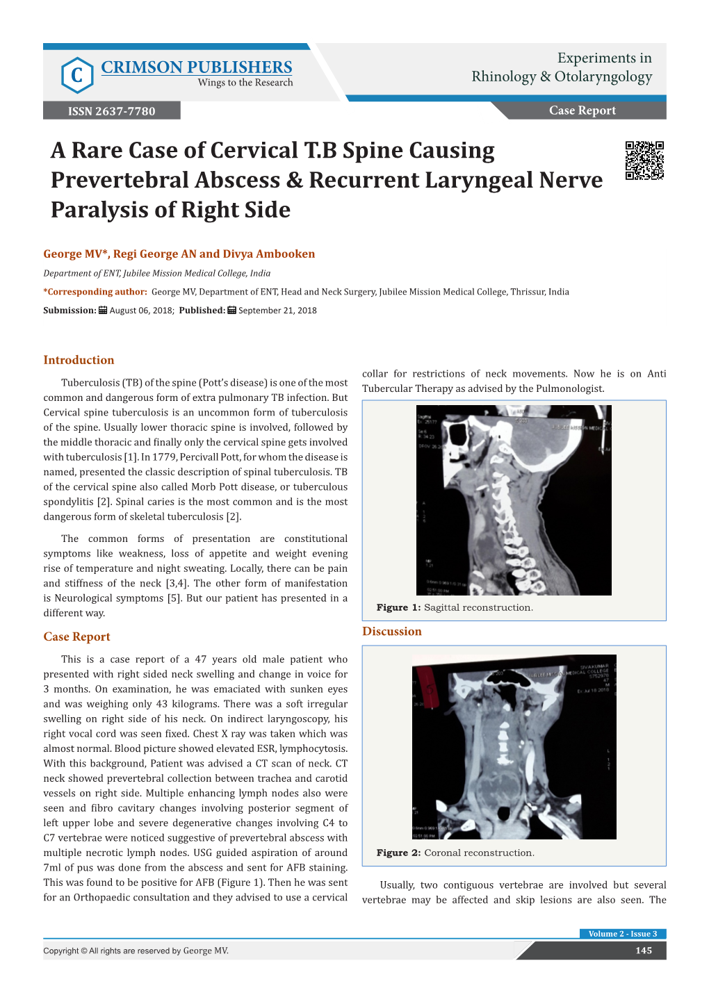 A Rare Case of Cervical T.B Spine Causing Prevertebral Abscess & Recurrent Laryngeal Nerve Paralysis of Right Side