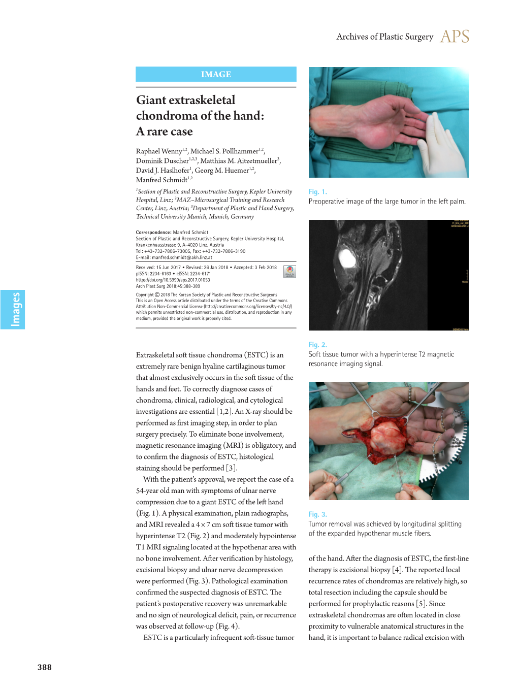 Giant Extraskeletal Chondroma of the Hand: a Rare Case