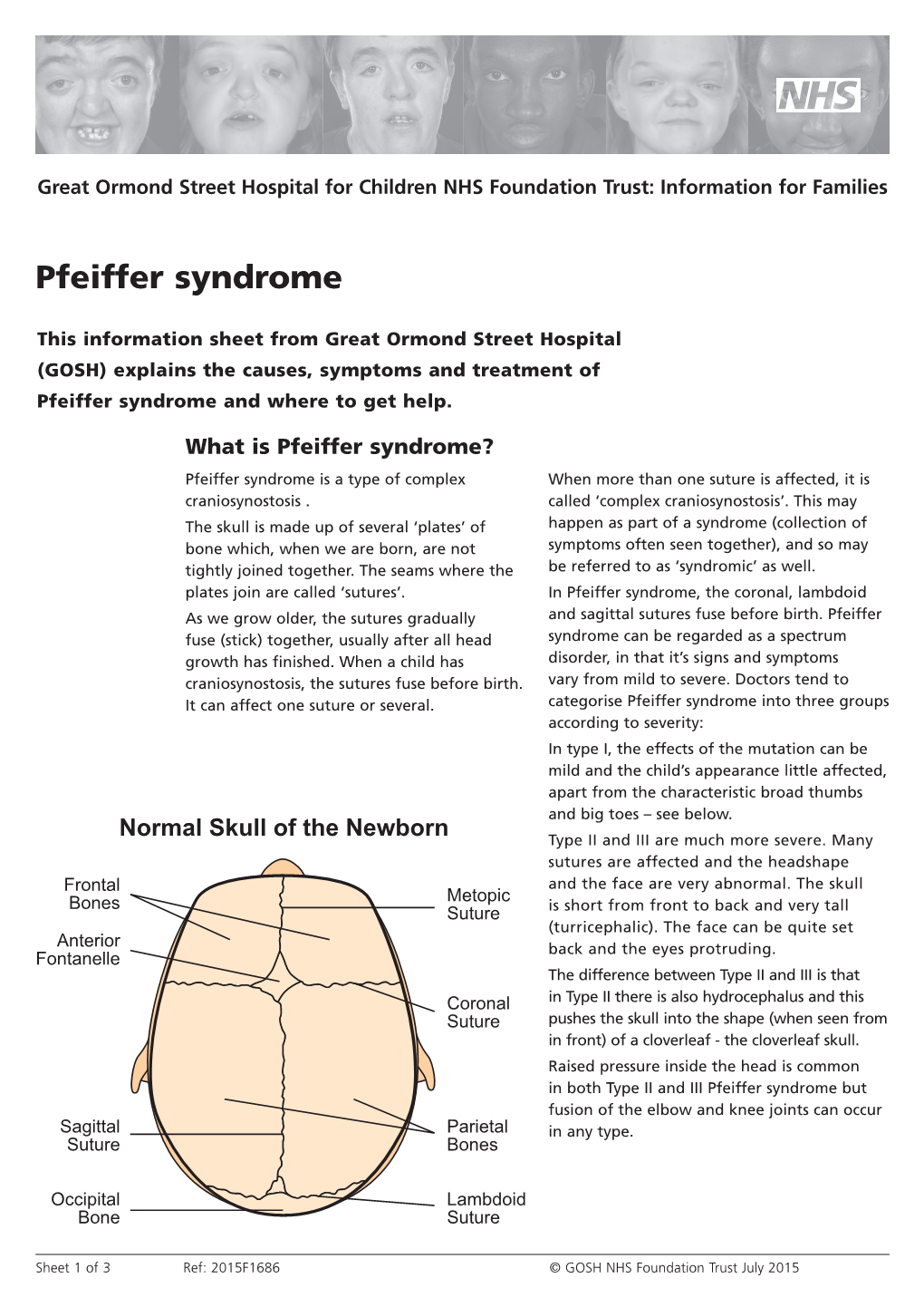 Pfeiffer Syndrome