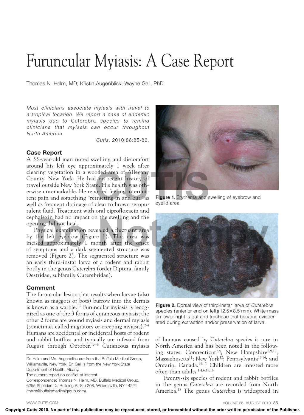 Furuncular Myiasis: a Case Report