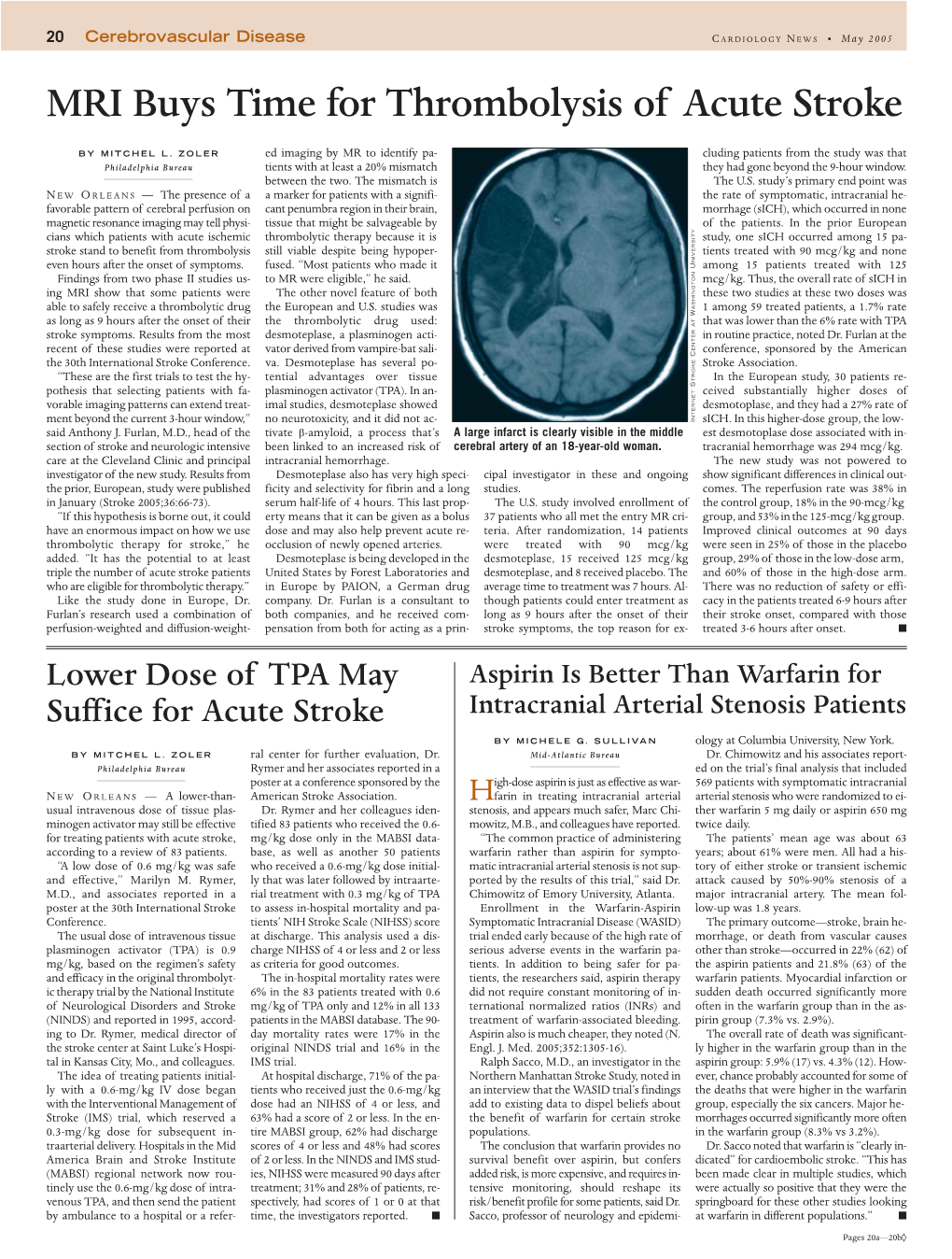 MRI Buys Time for Thrombolysis of Acute Stroke