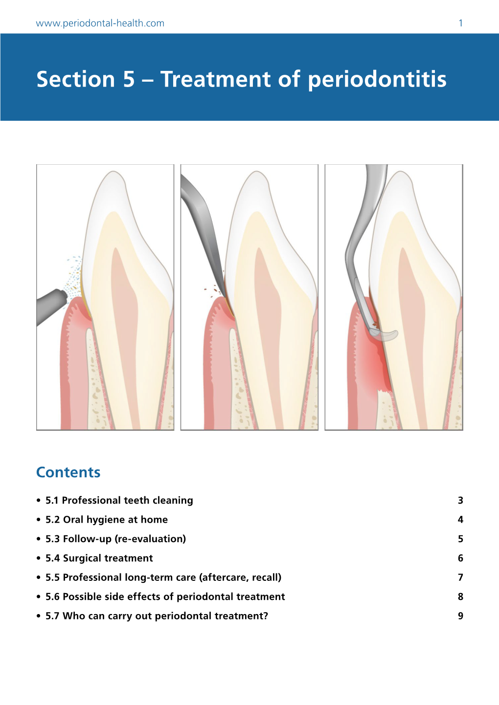 Section 5 – Treatment of Periodontitis
