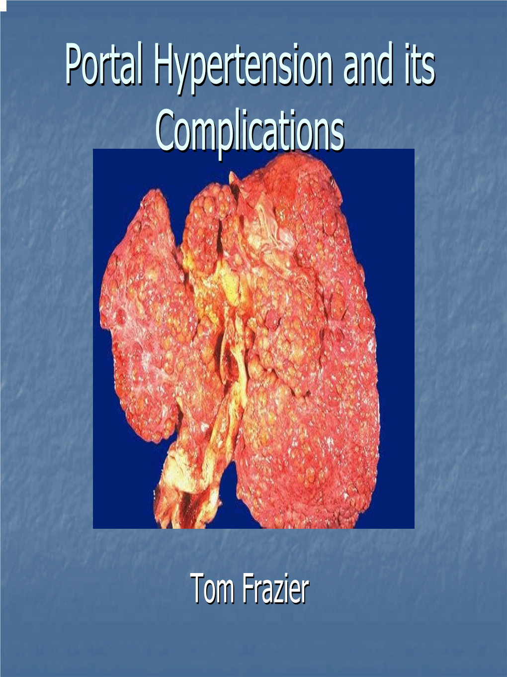 Portal Hypertension and Its Complications